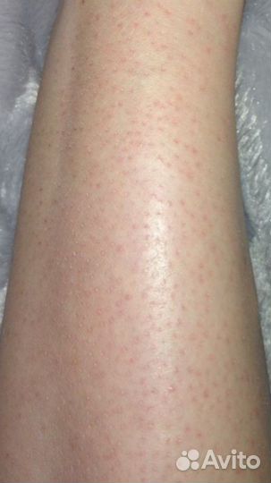 Электроэпиляция: глубокое бикини