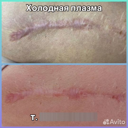 Холодная плазма