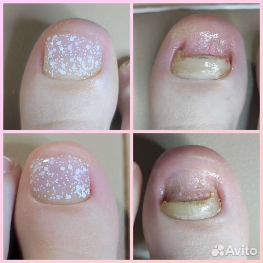 Подолог, педикюр, вросший ноготь, бородавка