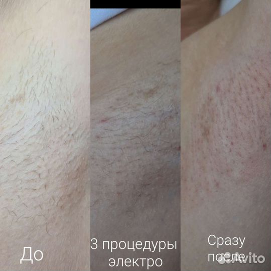 Электроэпиляция/Воск