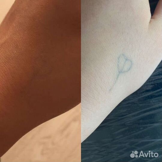 Удаление татуировок и татуажа. Карбоновый пилинг