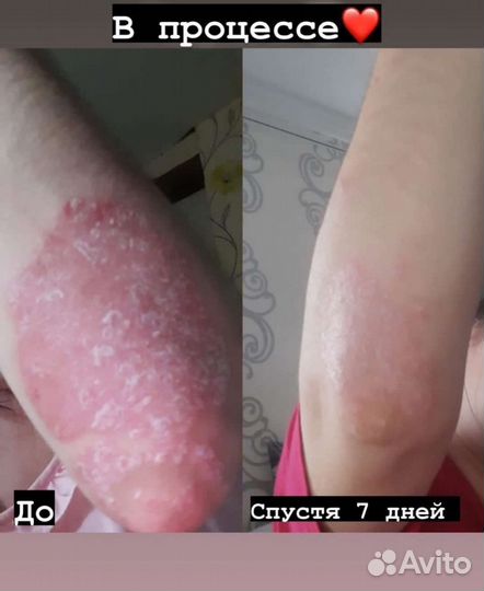 Средство от псориаза