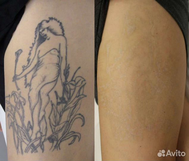 Лазерное удаление тату