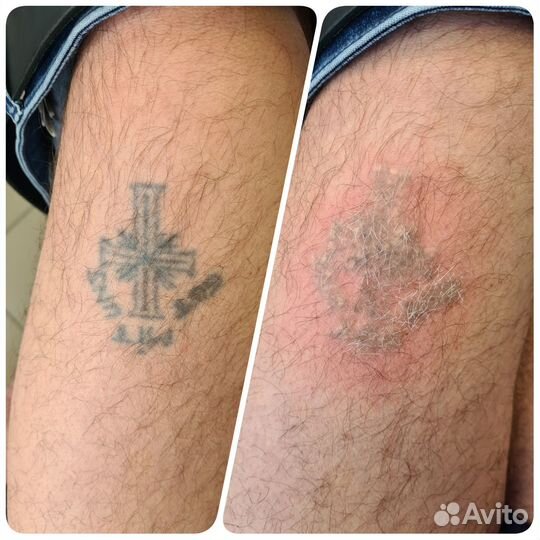 Удаление татуировки/татуажа лазером