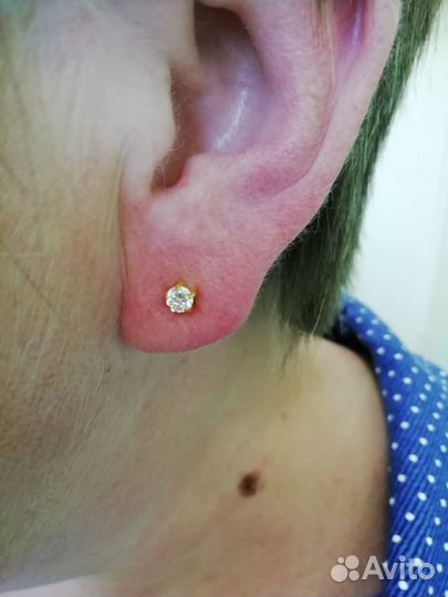 Карбокситерапия