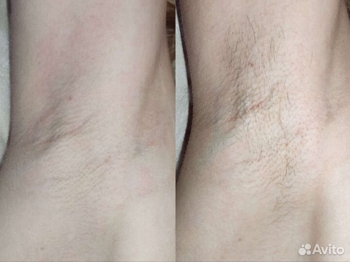 Депиляция воском: глубокое бикини