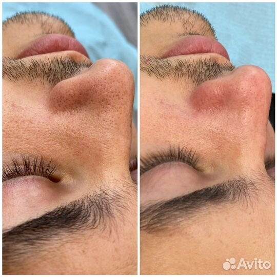 Чистка лица, массаж, дермапен