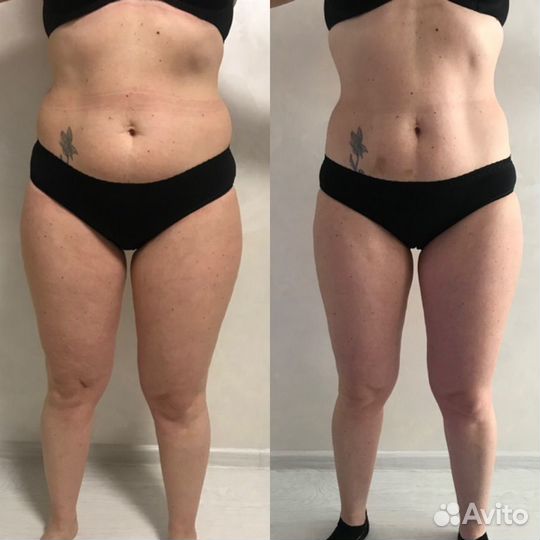 Антицеллюлитный массаж