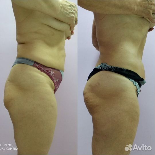 Антицеллюлитный вакуумный LPG массаж