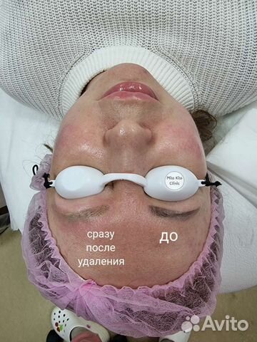 Удаление тату и татуажа. Требуются модели