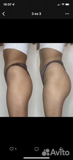 Увеличение ягодиц