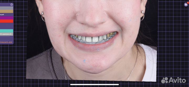 Зубной техник.Cad/cam.Зубные протезы