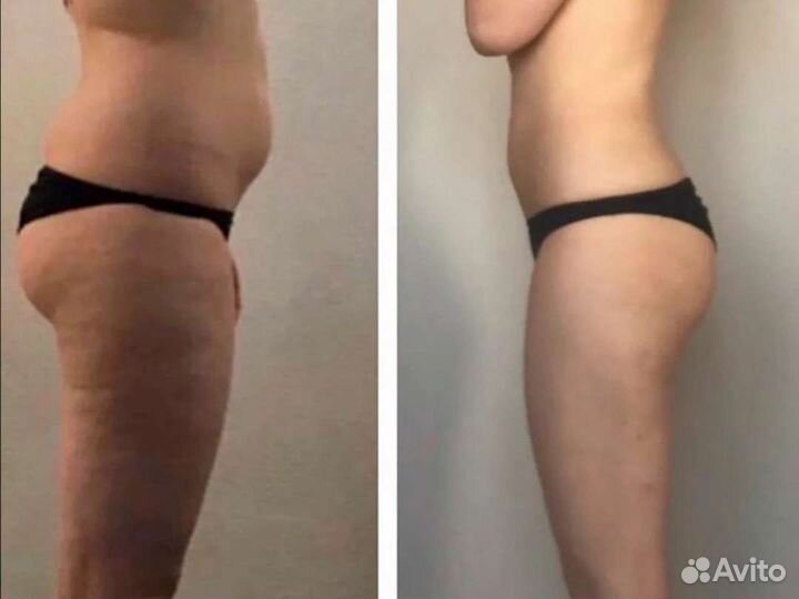 Липосоникс-Безоперационная Липосакция