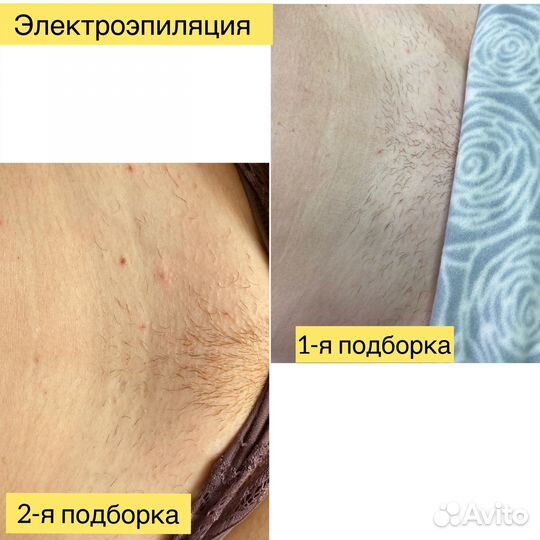 Электроэпиляция/Шугаринг/Депиляция воском