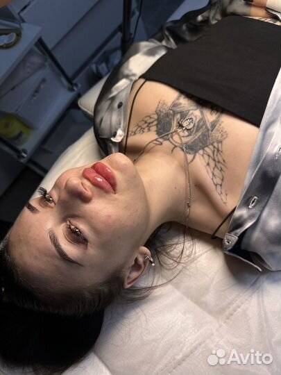 Увелечение губ скул подбородок