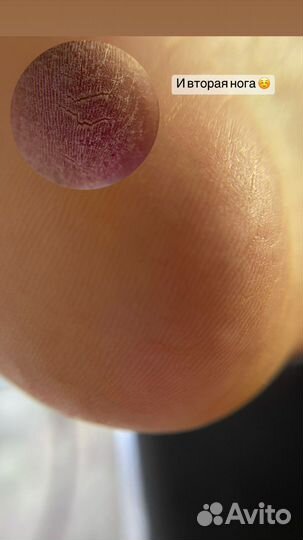 Педикюр, титановая нить