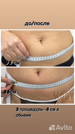 Процедура Индиба