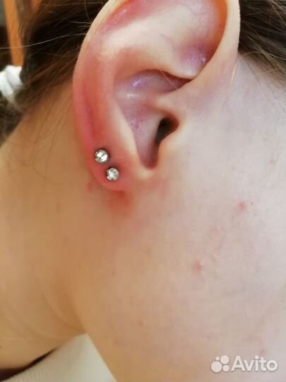 Карбокситерапия