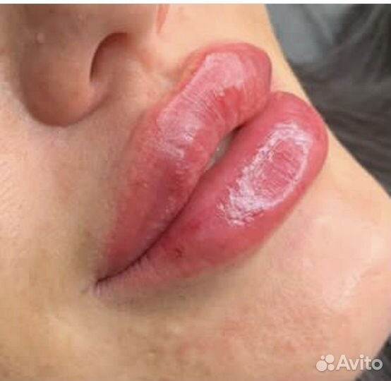 Инъекции ботокса в губы