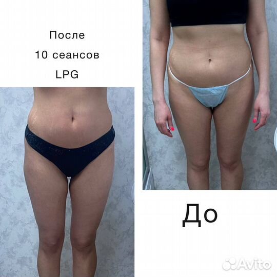 LPG, прессотерапия