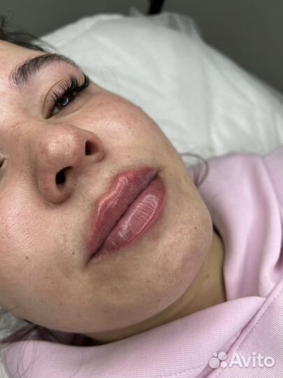 Биоревитализация