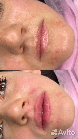 Увеличение губ