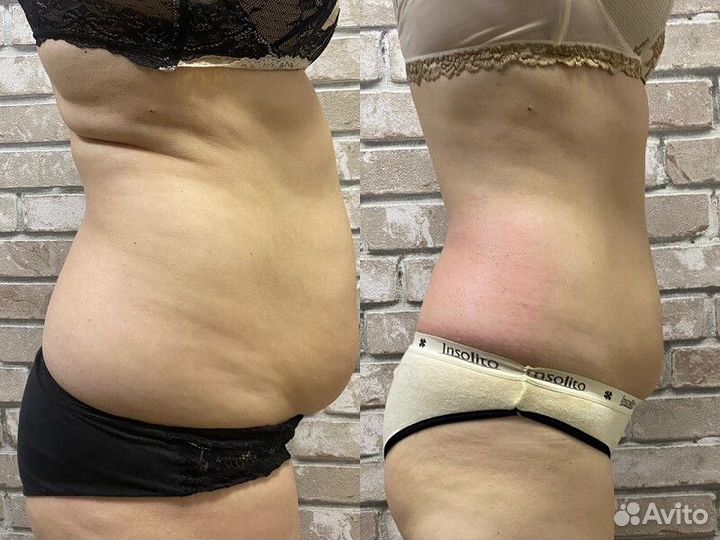 Антицеллюлитный массаж vela shape / пр Просвещения