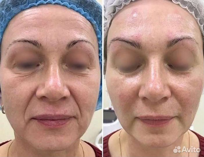 Безоперационная подтяжка лица / RF - лифтинг