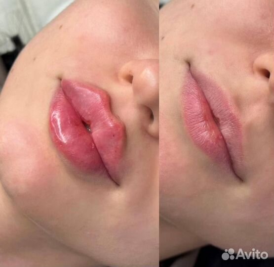 Модель на увеличение губ и ботокс