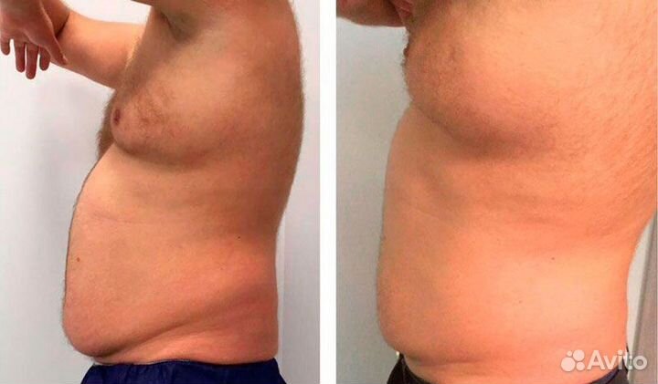 Криолиполиз похудение липосакция для мужчин