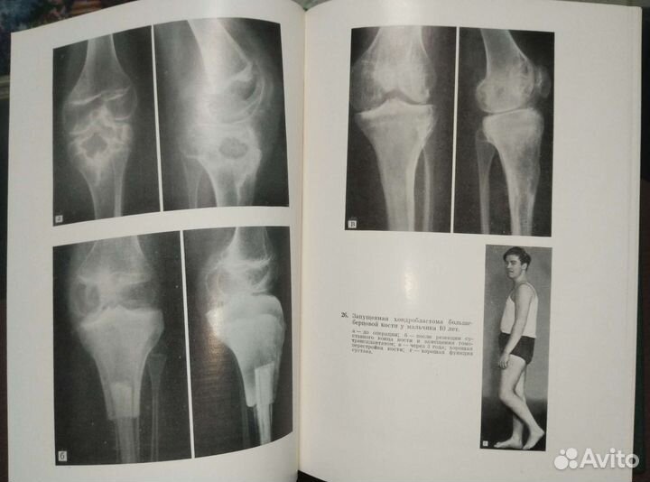 Болезни костей у детей. М.В.Волков.ссср 1974г