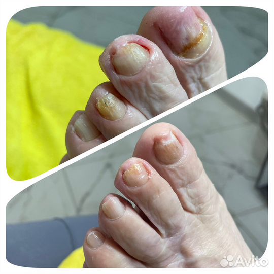 Лечебный педикюр подолог