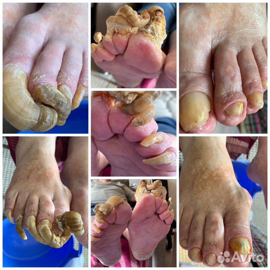 Медицинский педикюр.Выезд на дом.Любой р-он