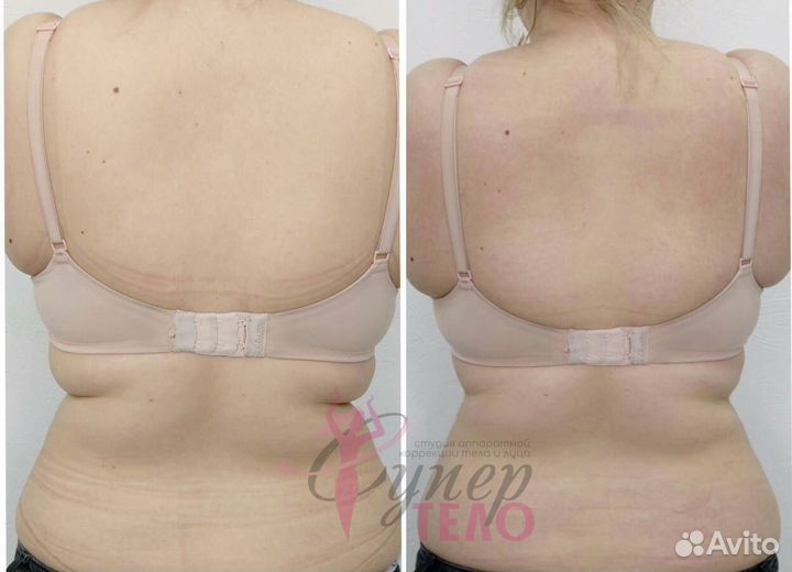 Кавитация/Вакуумный массаж/Коррекция фигуры