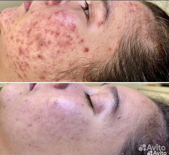 Ищу модель на чистое лицо (heleo 4 )