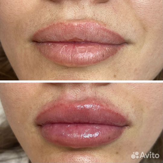 Модель на увеличение губ