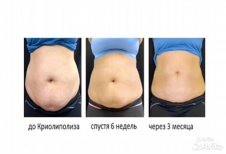 Липосакция без операции в Тольятти