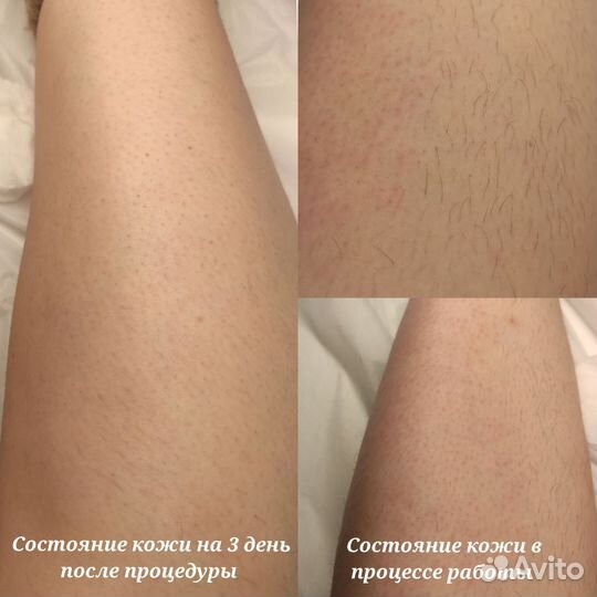 Электроэпиляция Apilus(можно в 4 руки)