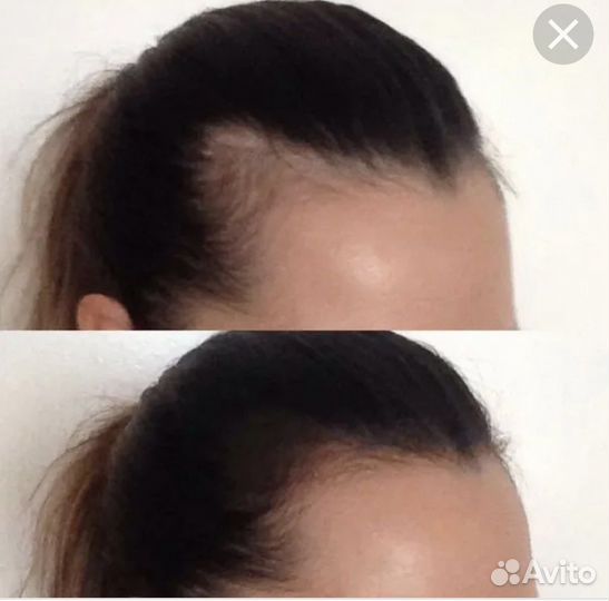 Трихопигментация