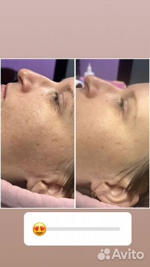 Фракционная мезотерапия/микронидлинг/bbglow