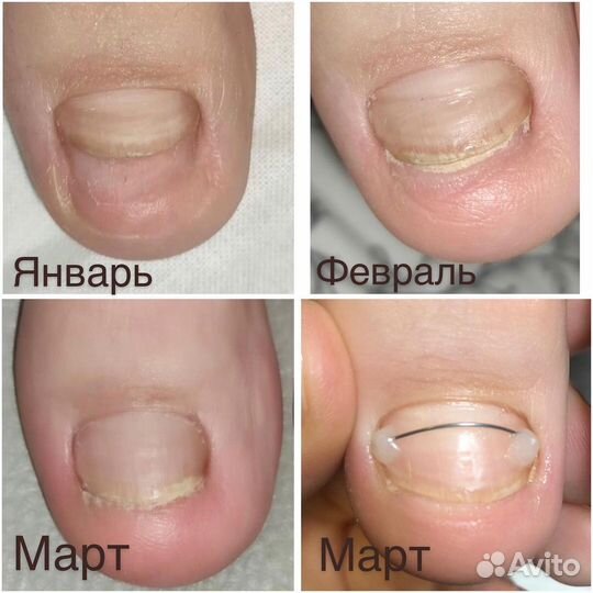 Подолог. Медицинский педикюр. Титановая нить