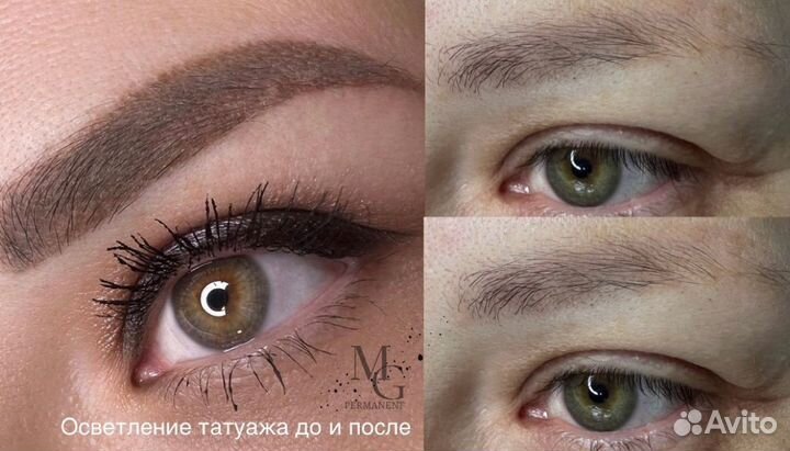 Удаление татуажа м.Окская