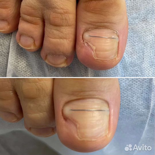 Подолог, педикюр. Выезд на дом по Приморскому р-ну