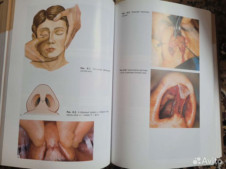 Оториноларингология национальное руководство