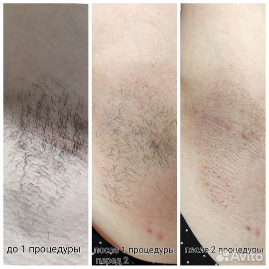 Электроэпиляция