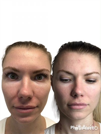 Скульптурный массаж лица