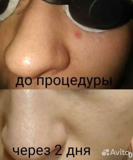 Карбоновый пилинг