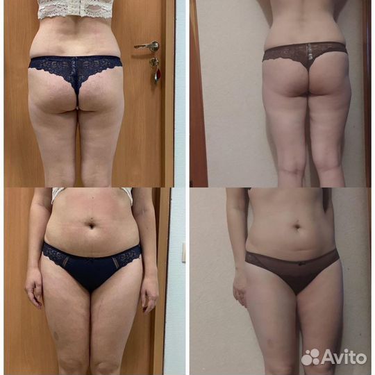 Коррекция фигуры LPG массаж