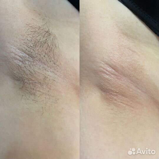 Женская и мужская Депиляции