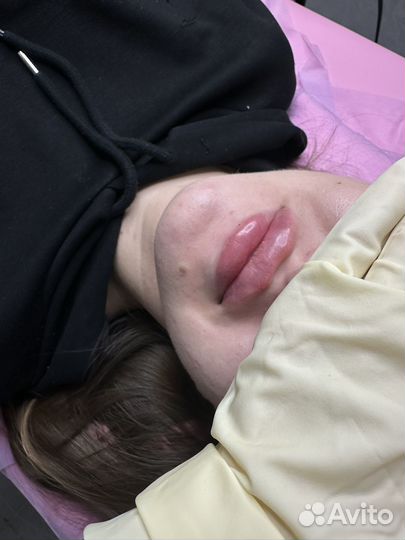 Увеличение губ